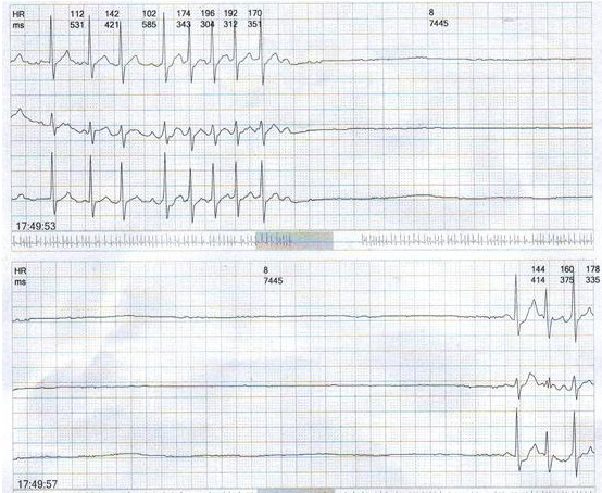 4s长间歇的窦性停搏